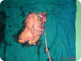 kidney tumor 1